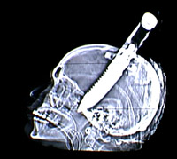 [Knife in the head. Courtesy NYT Television and Jacksonville
 Medical Center.]